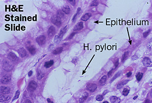 Helicobacter pylori as a causative agent of Gastric Cancer - microbewiki