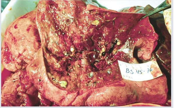 Treatments against Pseudomonas aeruginosa Biofilms in Cystic Fibrosis