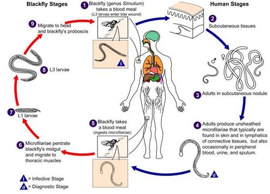 Onchocerciasis (Onchocerca volvulus) - microbewiki